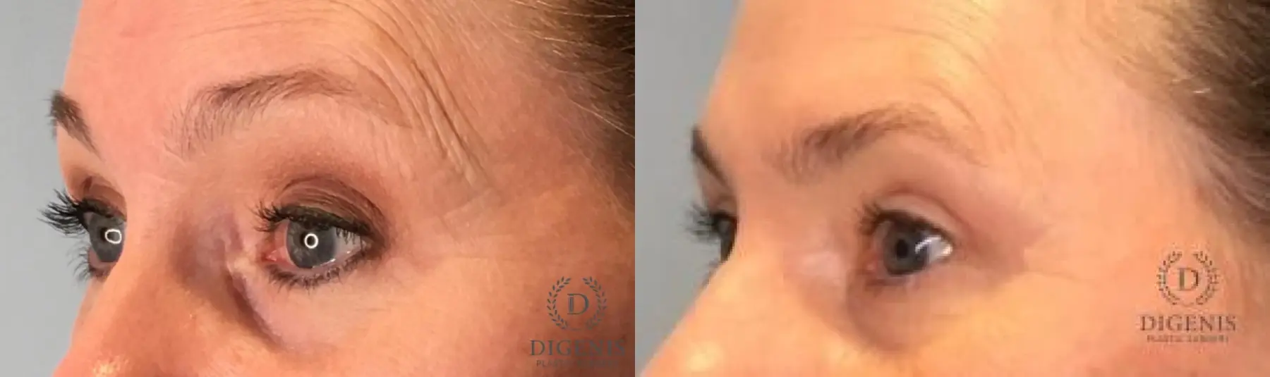 Eyelid Surgery: Patient 12 - Before and After 4
