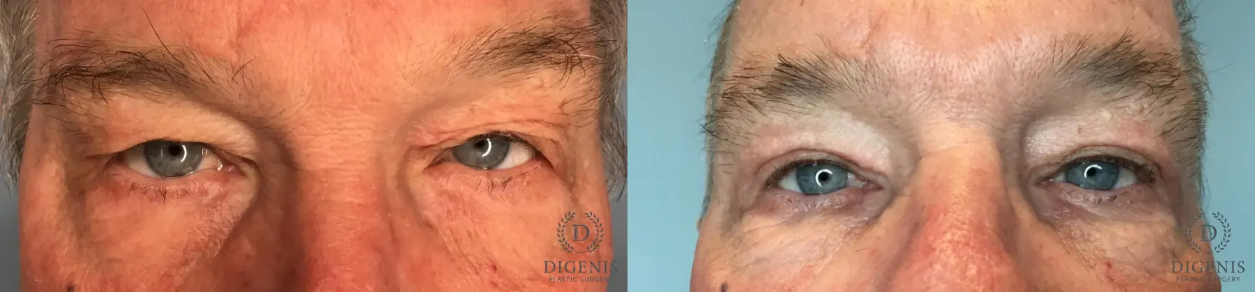 Eyelid Surgery: Patient 14 - Before and After  