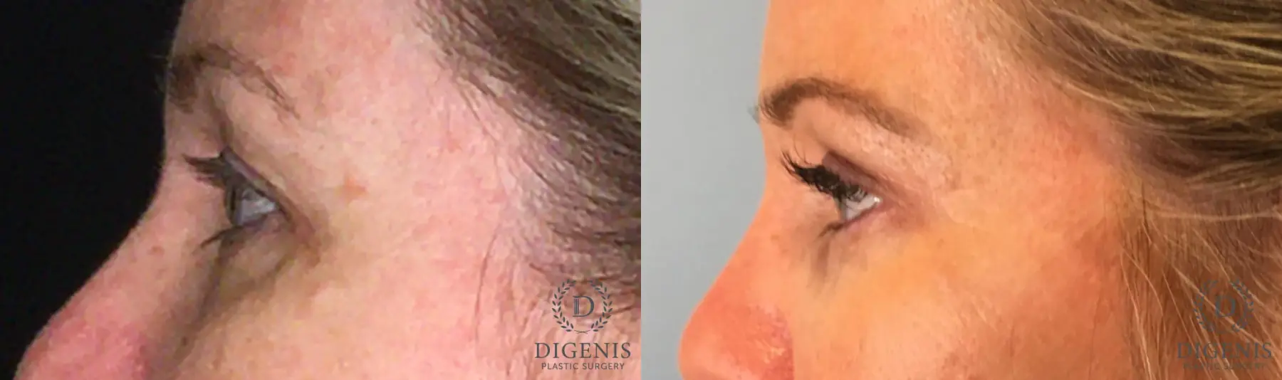 Eyelid Surgery: Patient 52 - Before and After 4