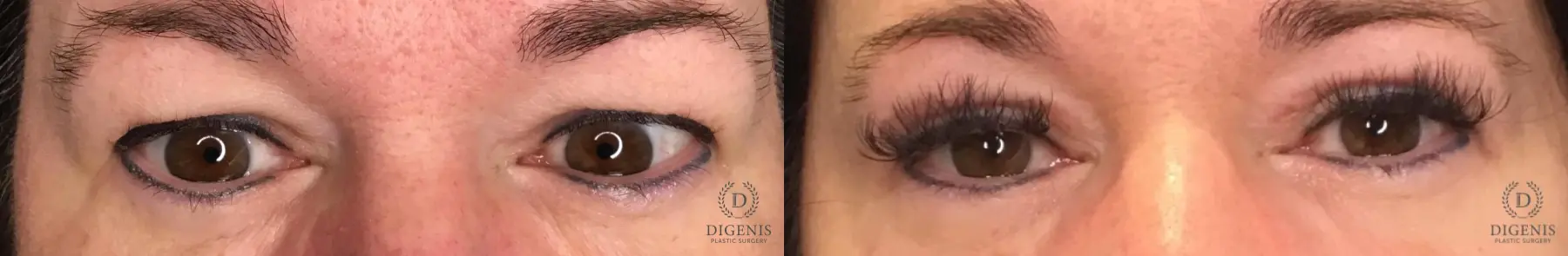 Eyelid Surgery: Patient 1 - Before and After  