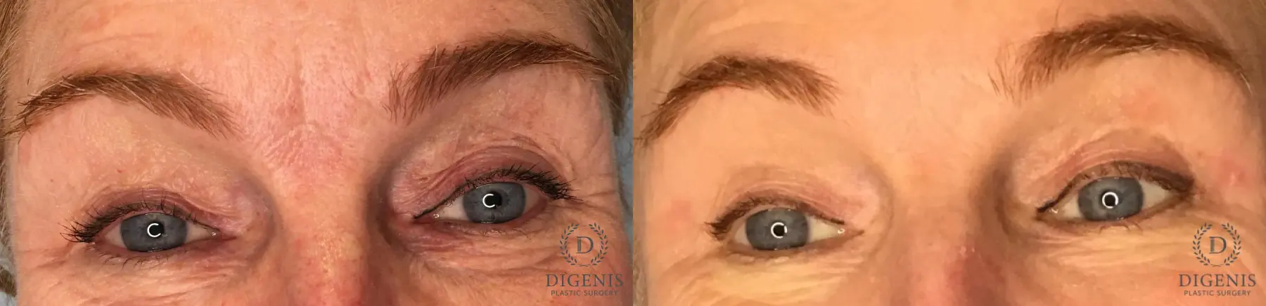 Eyelid Surgery: Patient 71 - Before and After 1