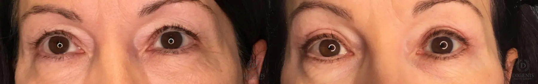 Eyelid Surgery: Patient 72 - Before and After 1