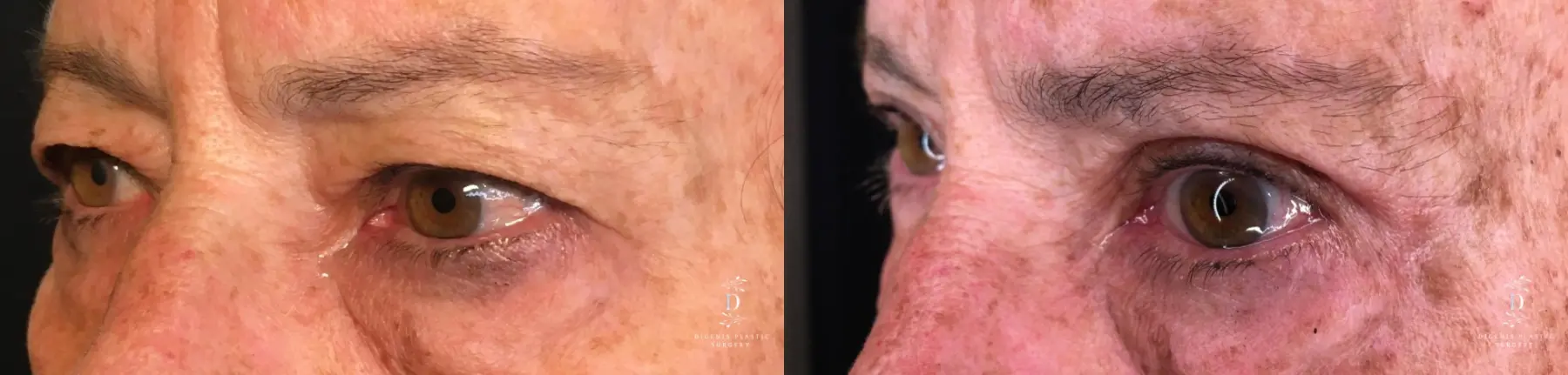 Eyelid Surgery: Patient 26 - Before and After 4
