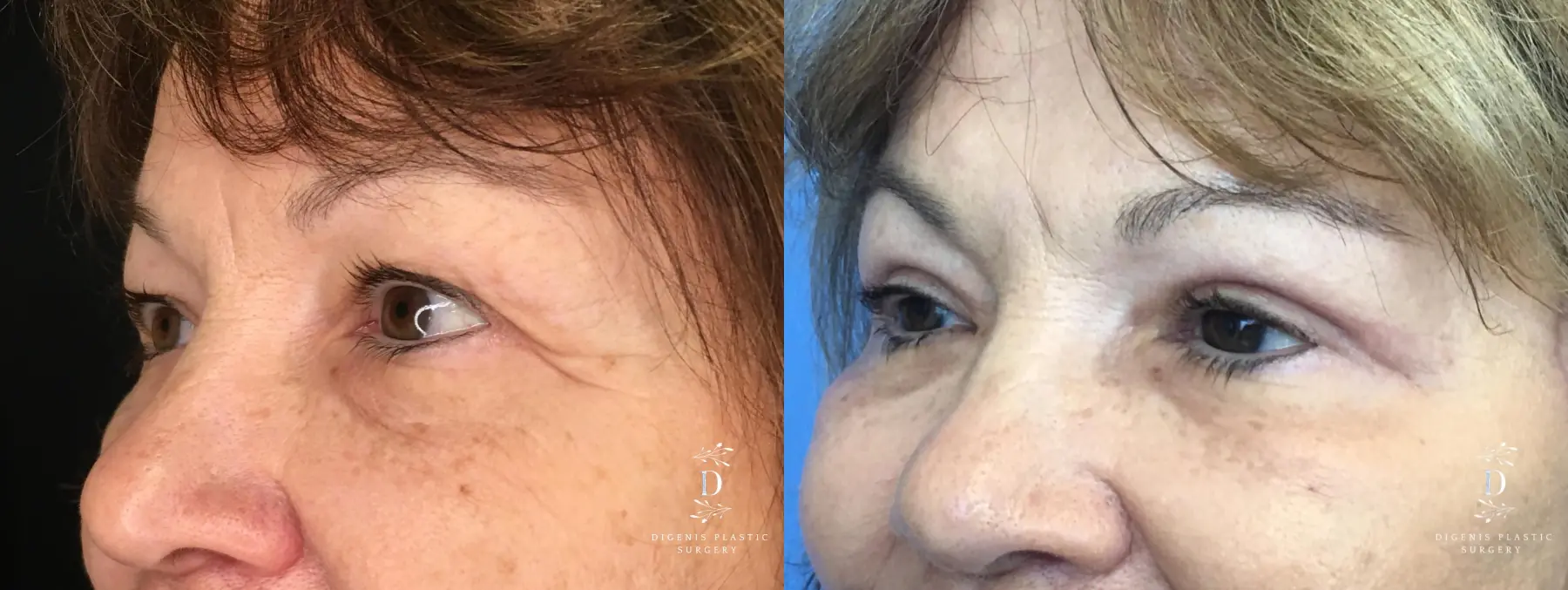 Eyelid Surgery: Patient 20 - Before and After 4
