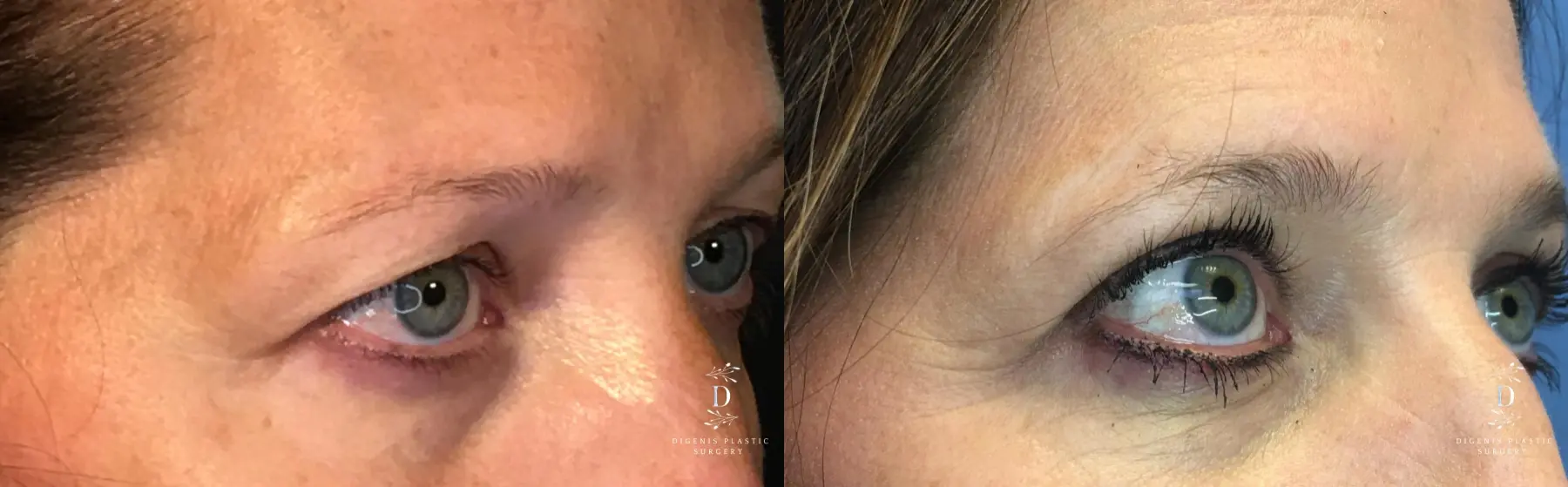 Eyelid Surgery: Patient 17 - Before and After 2