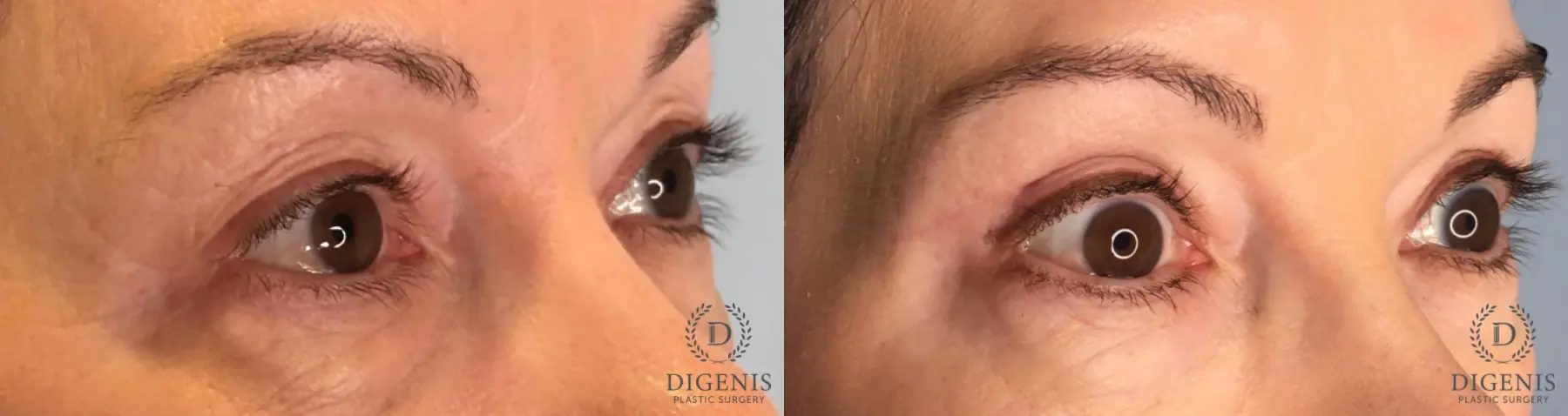 Eyelid Surgery: Patient 72 - Before and After 2