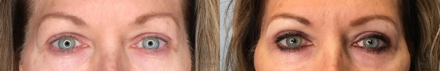 Eyelid Surgery: Patient 56 - Before and After  