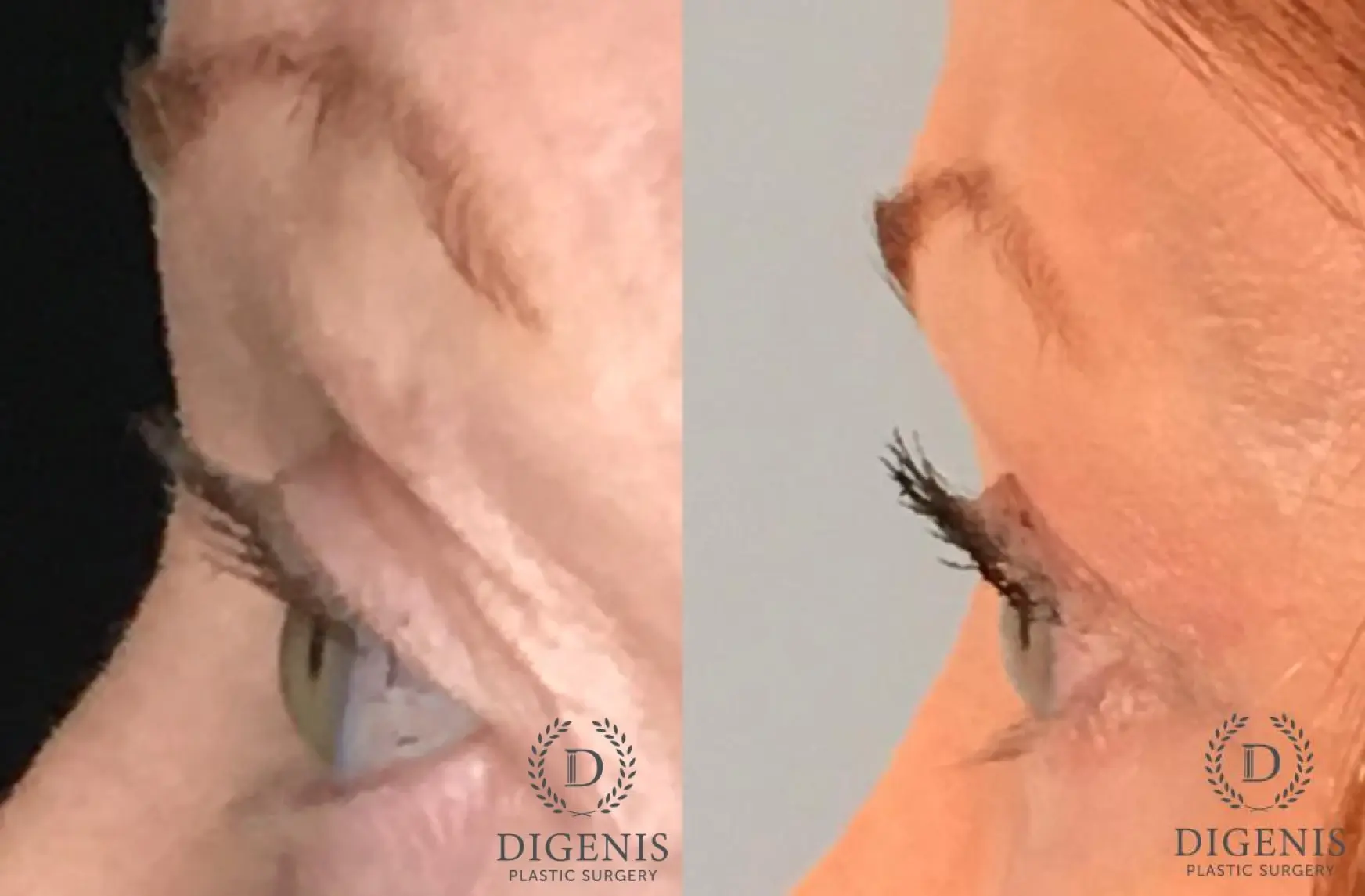 Eyelid Surgery: Patient 53 - Before and After 3