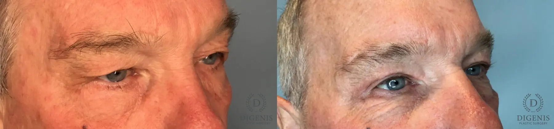 Eyelid Surgery: Patient 14 - Before and After 4