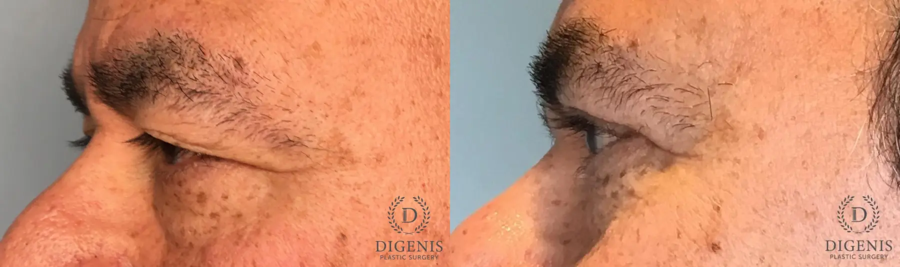 Eyelid Surgery: Patient 82 - Before and After 5