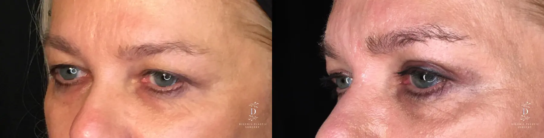 Eyelid Surgery: Patient 21 - Before and After 2
