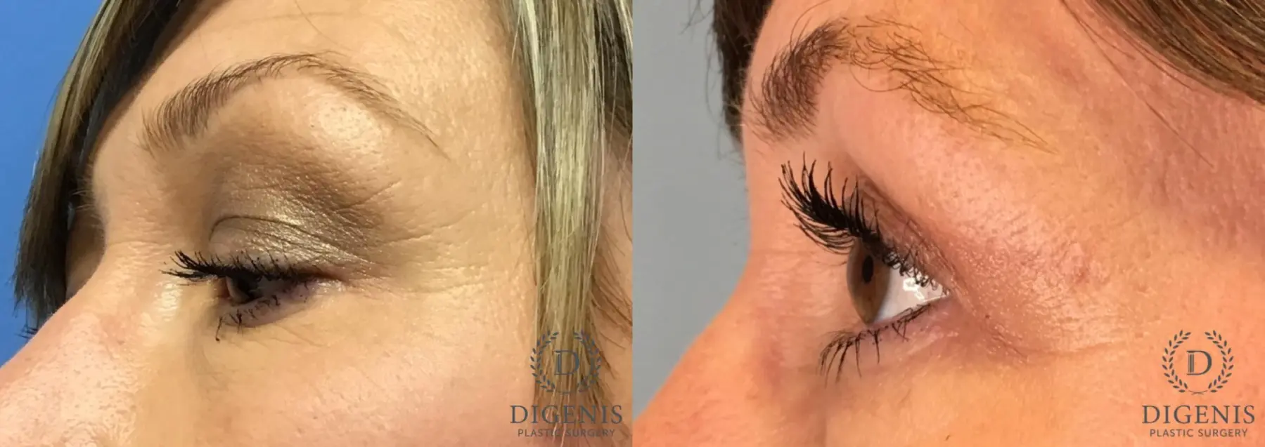 Eyelid Surgery: Patient 63 - Before and After 3