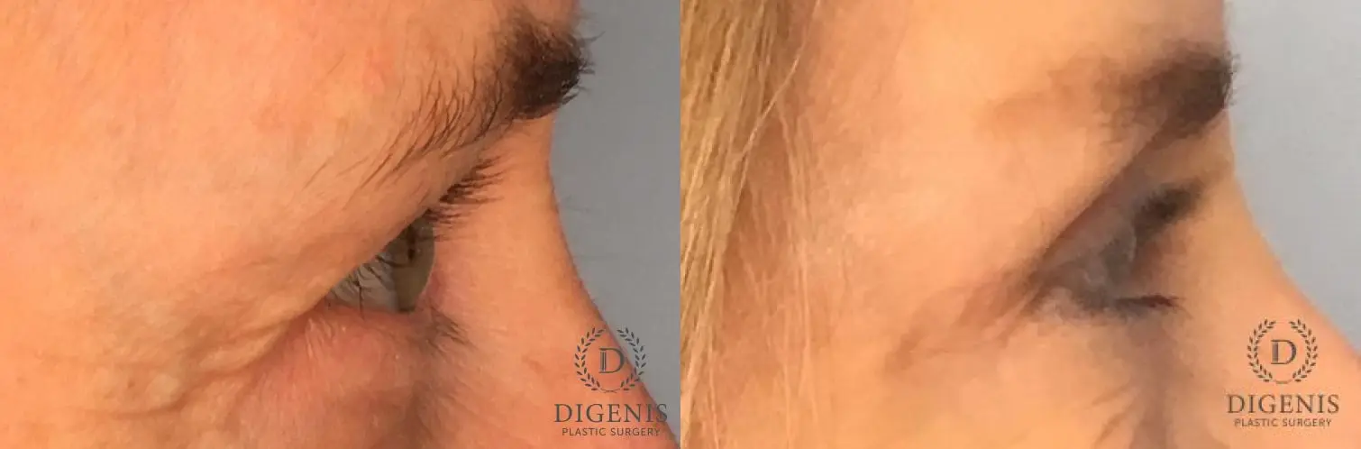 Eyelid Surgery: Patient 66 - Before and After 5