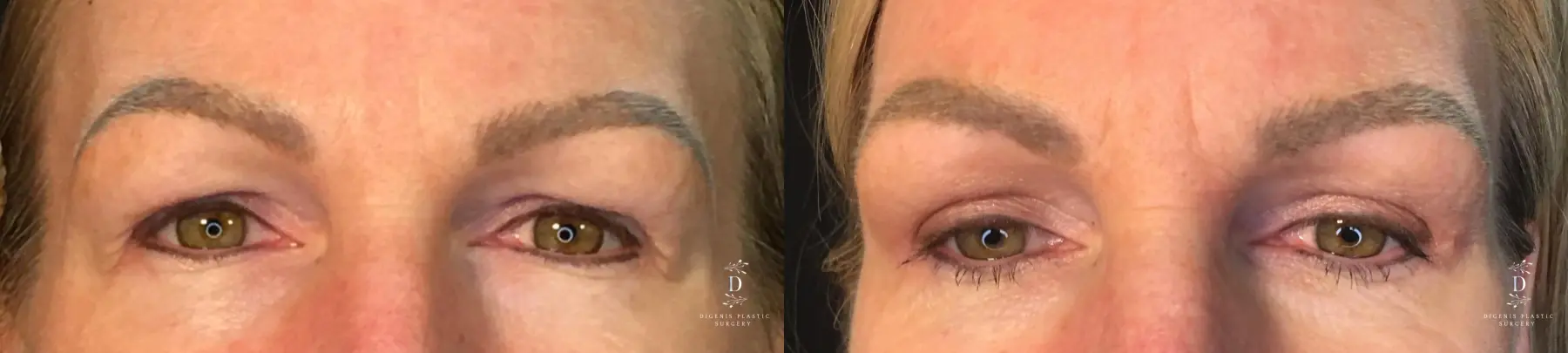 Eyelid Surgery: Patient 18 - Before and After  
