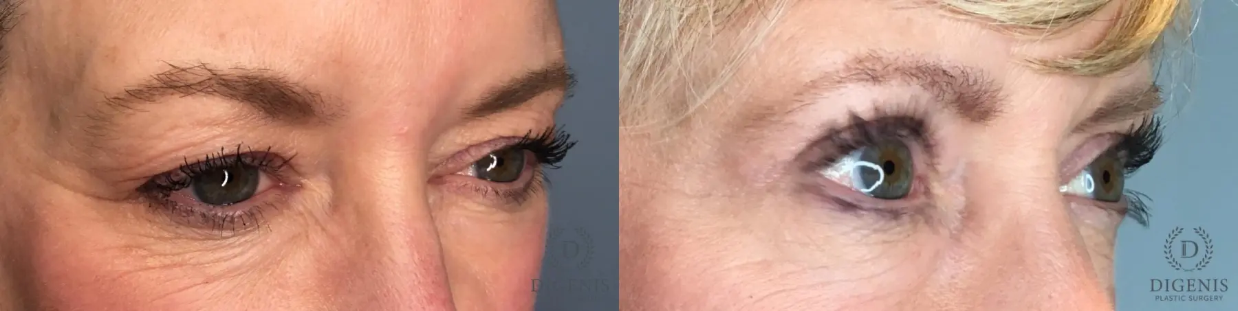 Eyelid Surgery: Patient 80 - Before and After 4