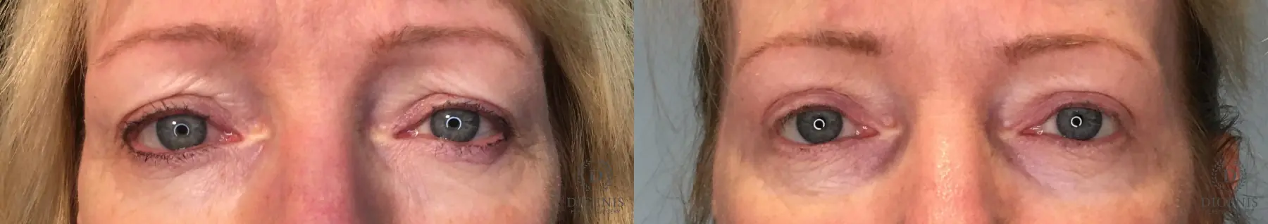 Eyelid Surgery: Patient 34 - Before and After 1