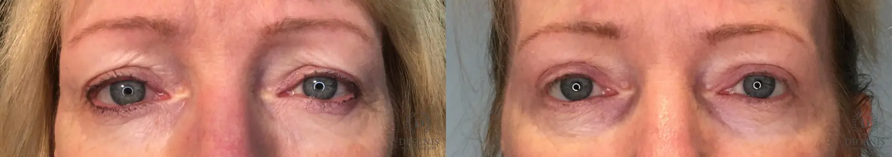 Eyelid Surgery: Patient 34 - Before and After  