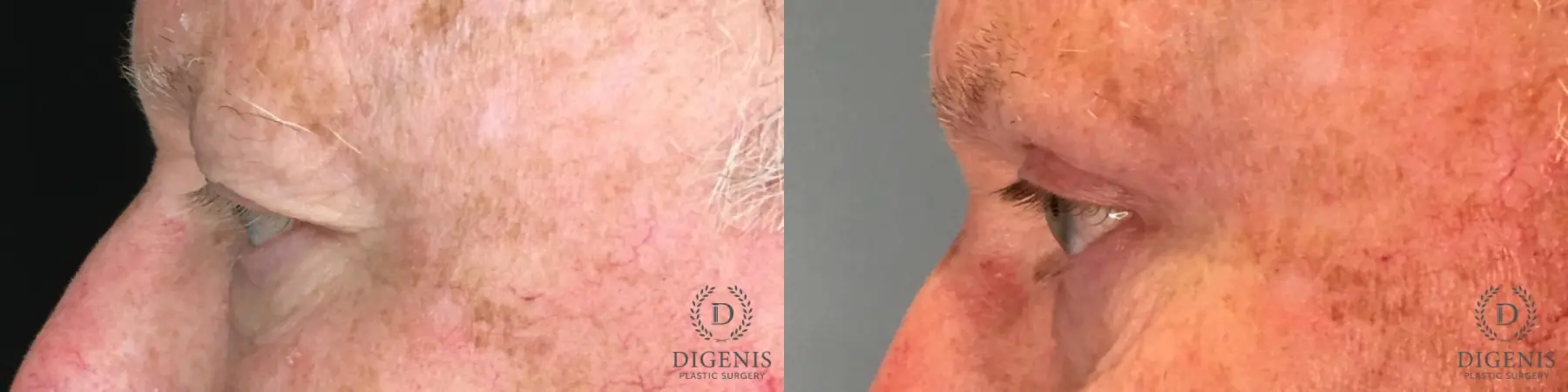 Eyelid Surgery: Patient 54 - Before and After 5