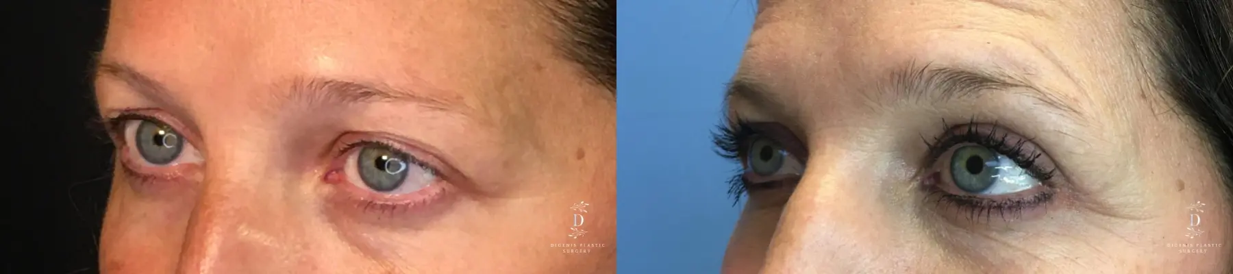 Eyelid Surgery: Patient 17 - Before and After 4