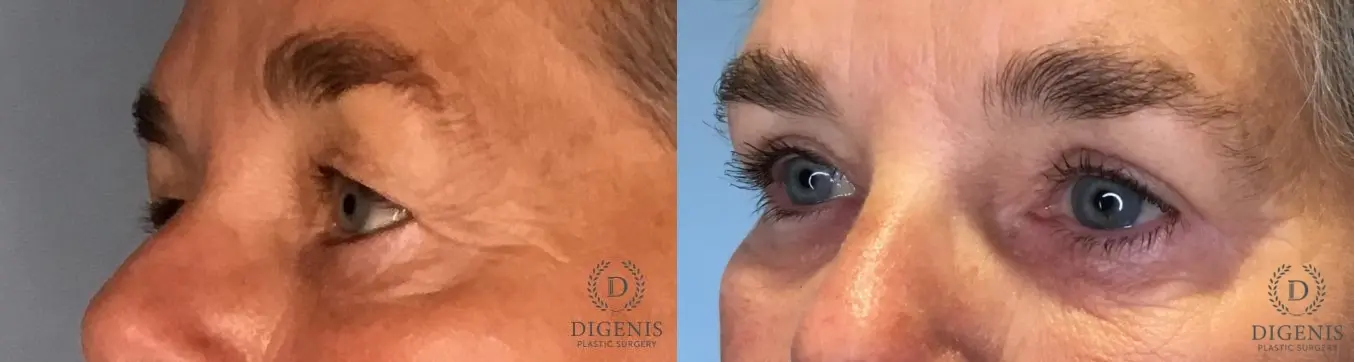 Eyelid Surgery: Patient 76 - Before and After 4