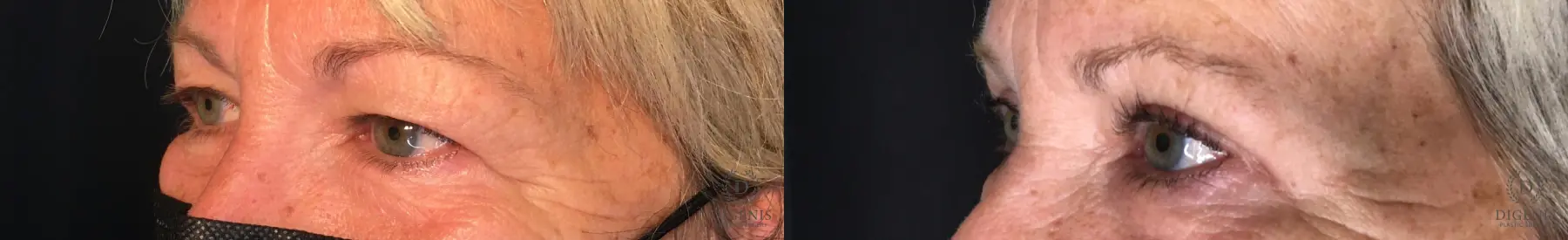 Eyelid Surgery: Patient 55 - Before and After 4