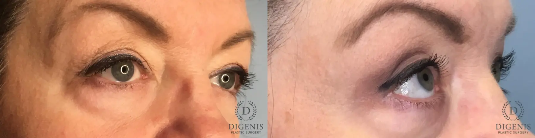 Eyelid Surgery: Patient 9 - Before and After 2