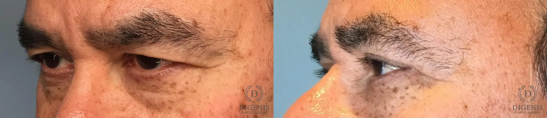 Eyelid Surgery: Patient 82 - Before and After 4