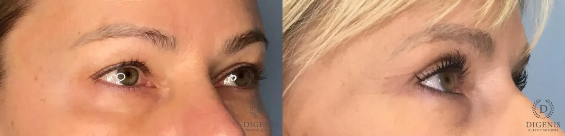 Eyelid Surgery: Patient 24 - Before and After 2