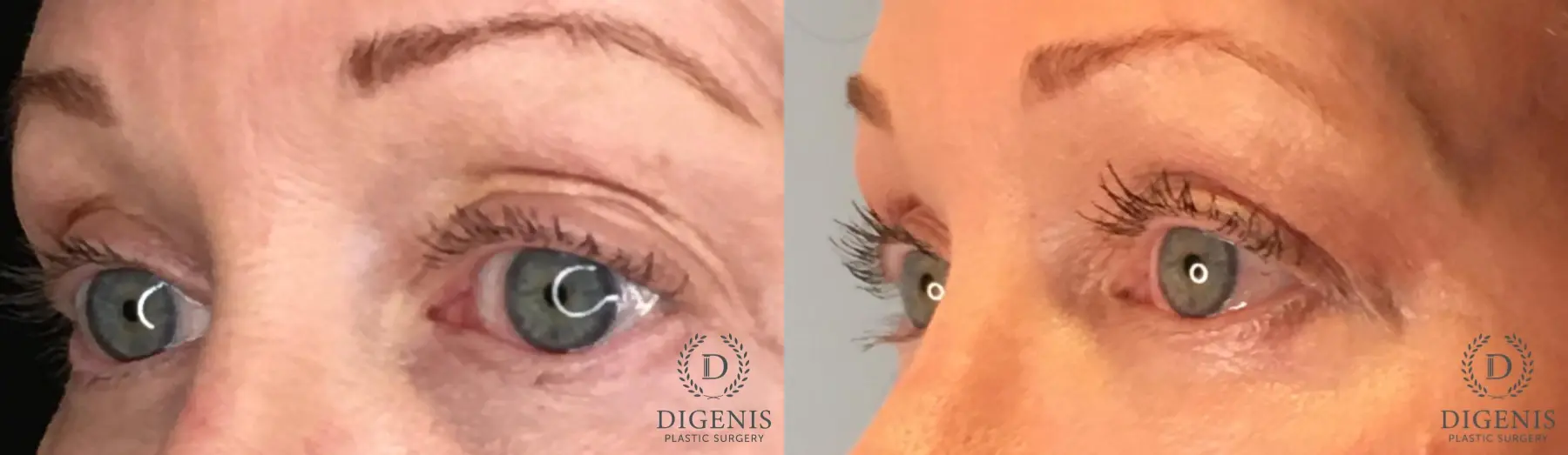 Eyelid Surgery: Patient 53 - Before and After 2