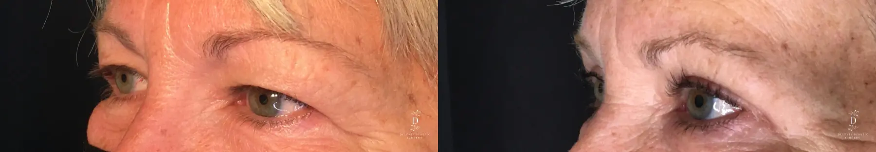 Eyelid Surgery: Patient 33 - Before and After 4