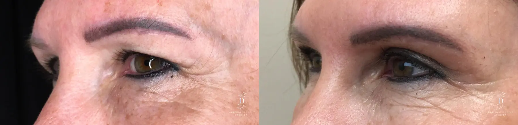 Eyelid Surgery: Patient 28 - Before and After 4