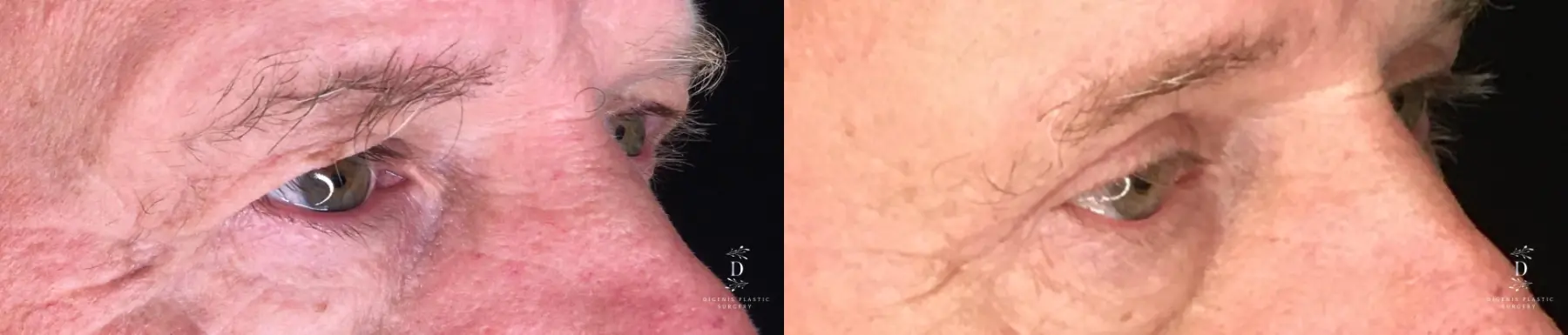 Eyelid Surgery: Patient 31 - Before and After 2