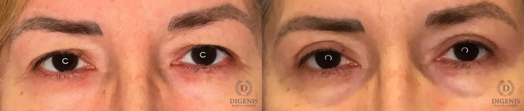 Eyelid Surgery: Patient 67 - Before and After 1