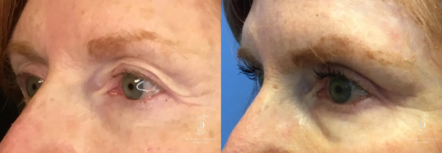 Eyelid Surgery: Patient 15 - Before and After 4