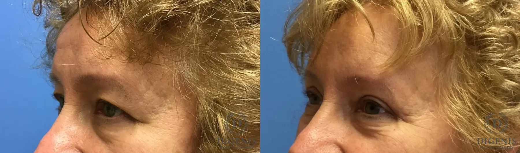 Eyelid Surgery: Patient 4 - Before and After 4