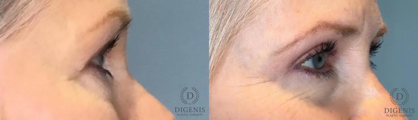 Eyelid Surgery: Patient 59 - Before and After 4