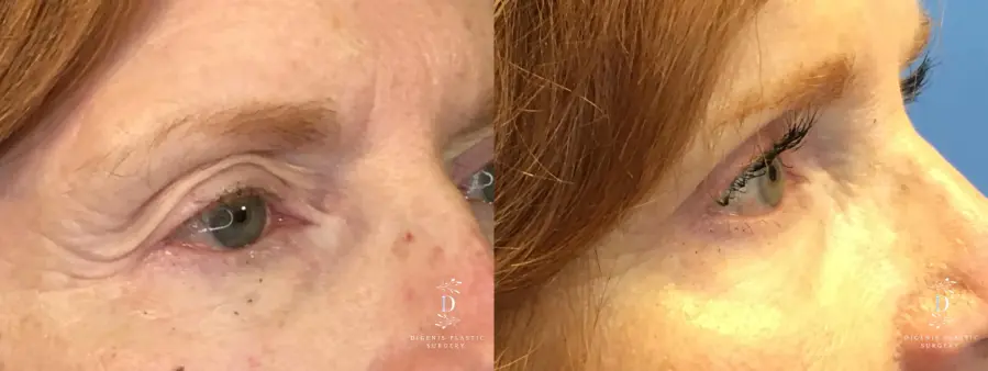 Eyelid Surgery: Patient 15 - Before and After 2