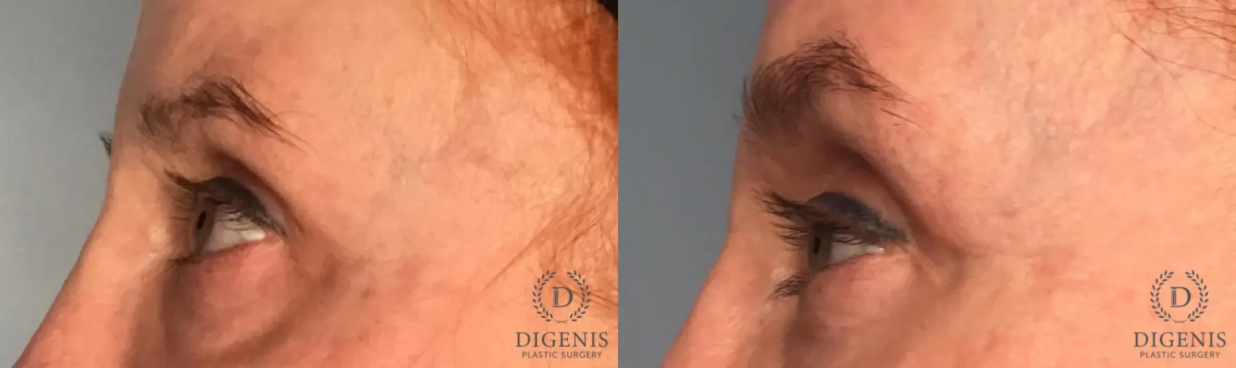Eyelid Surgery: Patient 7 - Before and After 3