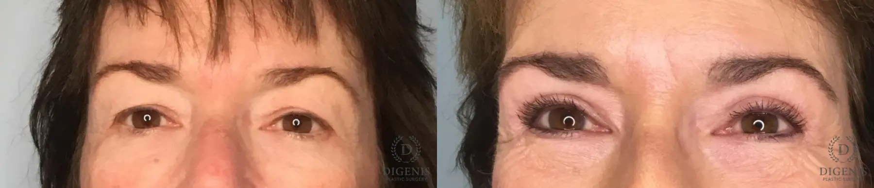 Eyelid Surgery: Patient 73 - Before and After 1