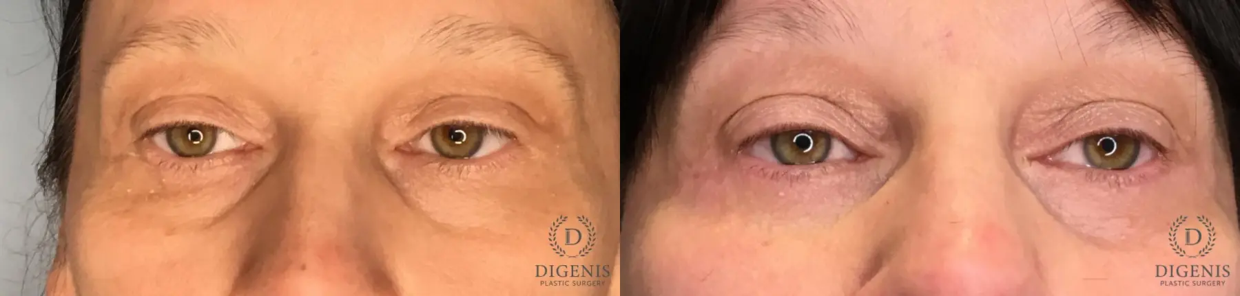 Eyelid Surgery: Patient 3 - Before and After  