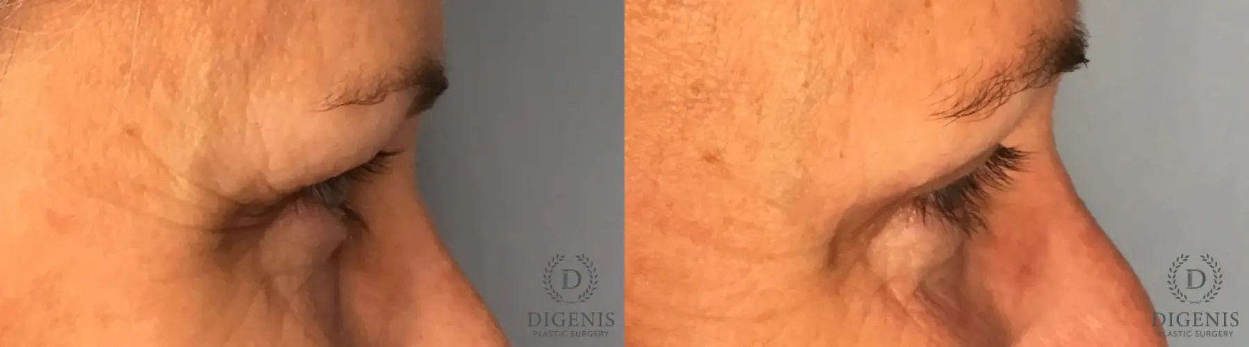 Eyelid Surgery: Patient 5 - Before and After 5