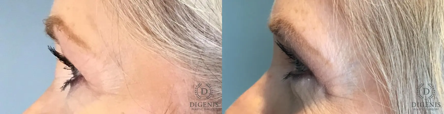 Eyelid Surgery: Patient 59 - Before and After 5