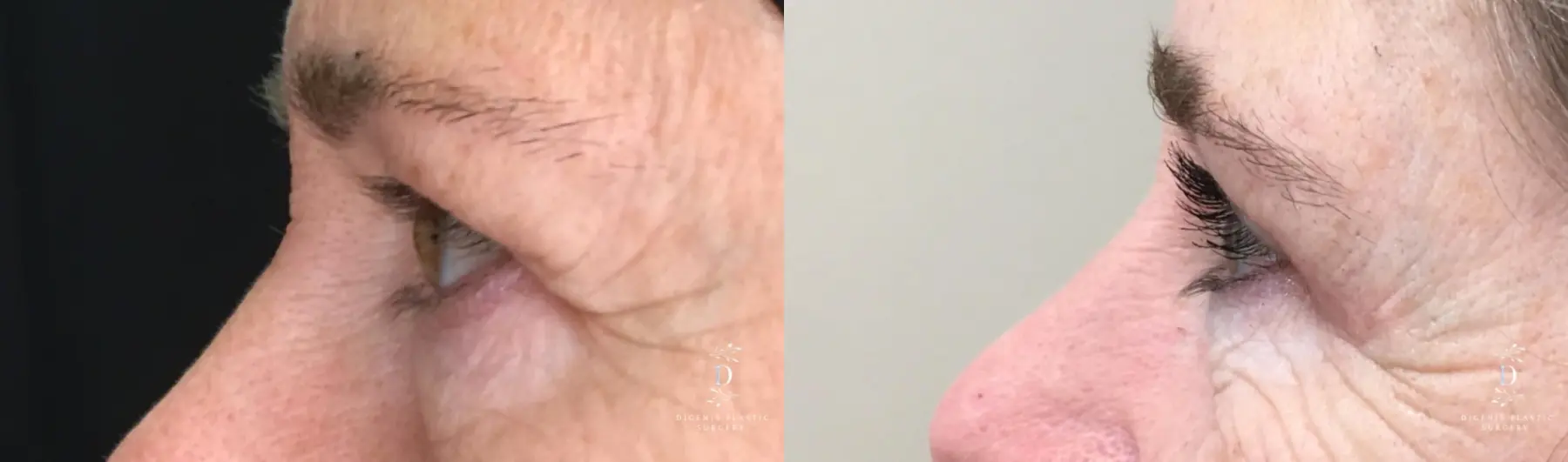 Eyelid Surgery: Patient 32 - Before and After 5
