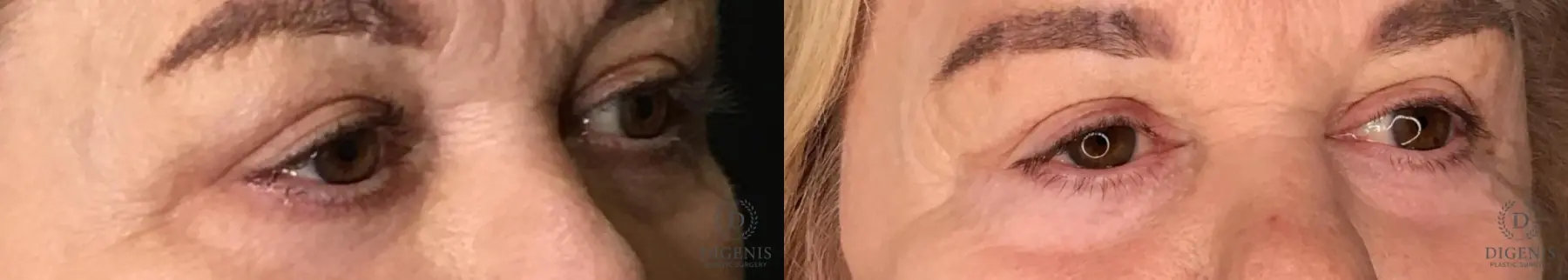 Eyelid Surgery: Patient 11 - Before and After 2