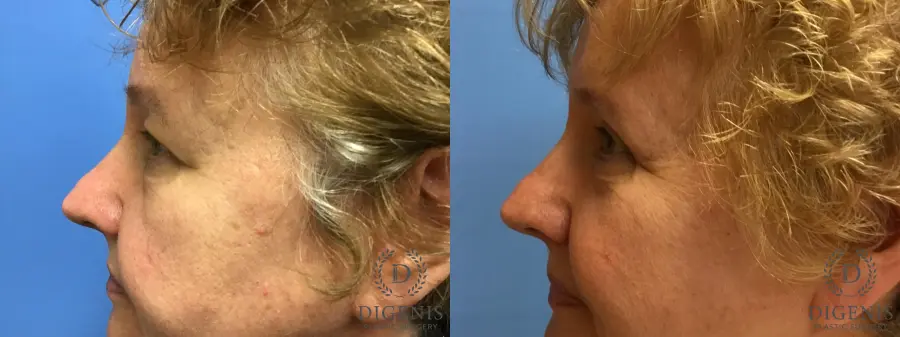 Eyelid Surgery: Patient 4 - Before and After 5