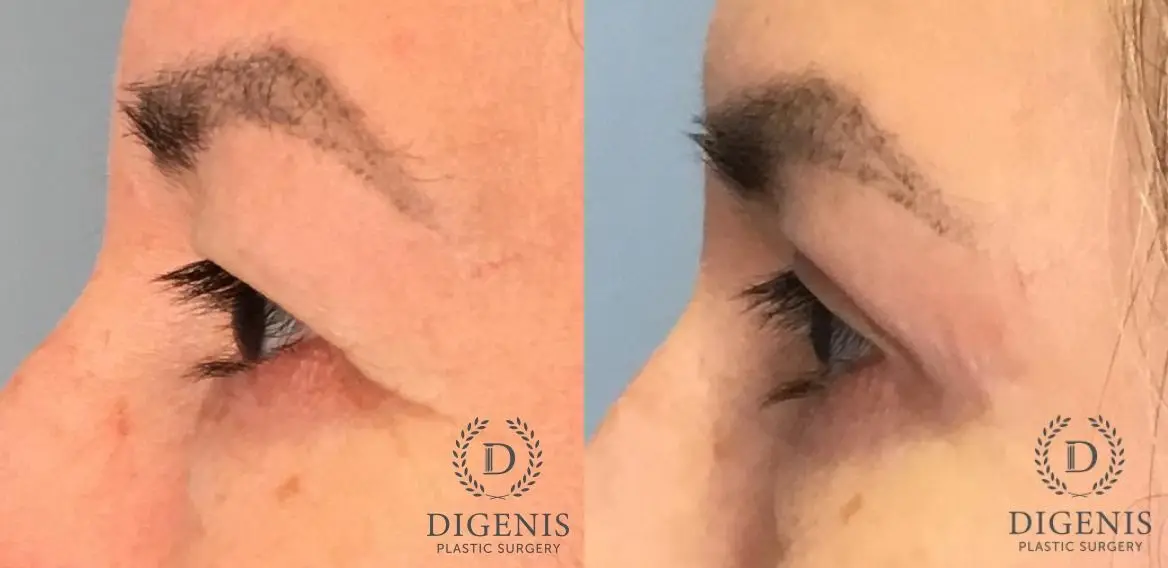 Eyelid Surgery: Patient 67 - Before and After 3