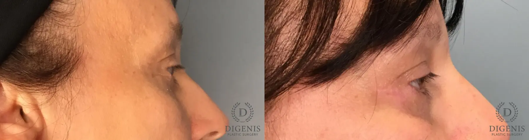 Eyelid Surgery: Patient 3 - Before and After 5
