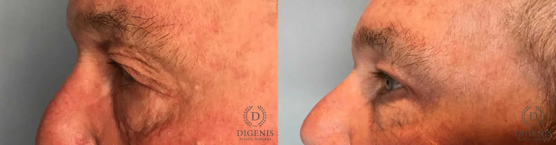 Eyelid Surgery: Patient 14 - Before and After 3