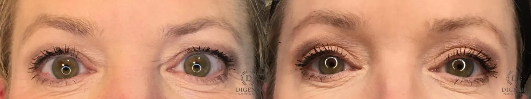 Eyelid Surgery: Patient 14 - Before and After  