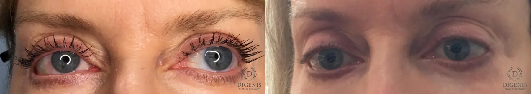 Eyelid Surgery: Patient 70 - Before and After 1